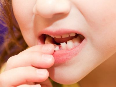 بیهوشی در دندانپزشکی کودکان