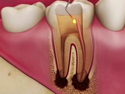 مراقبتهای پس از درمان ریشه دندان