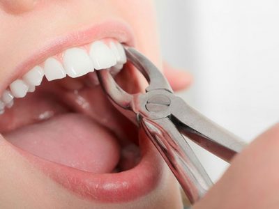 مراقبتهای پس از جراحی و کشیدن دندان