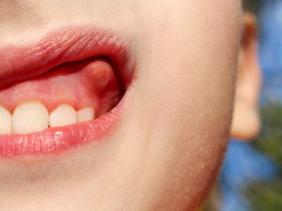 کیست دندان چیست؟ علائم و روش درمان