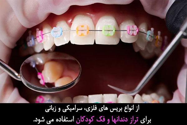 تراز دندانها و فک کودکان در ارتودنسی