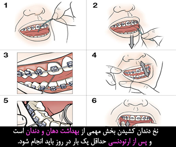 نحوه نخ دندان کشیدن پس از ارتودنسی
