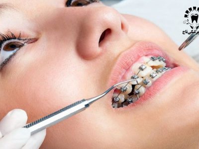 مزایا و معایب ارتودنسی دندان در اسلامشهر