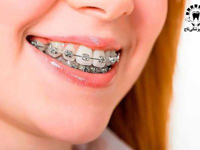 تأثیر ارتودنسی دندان بر روی لب‌ها