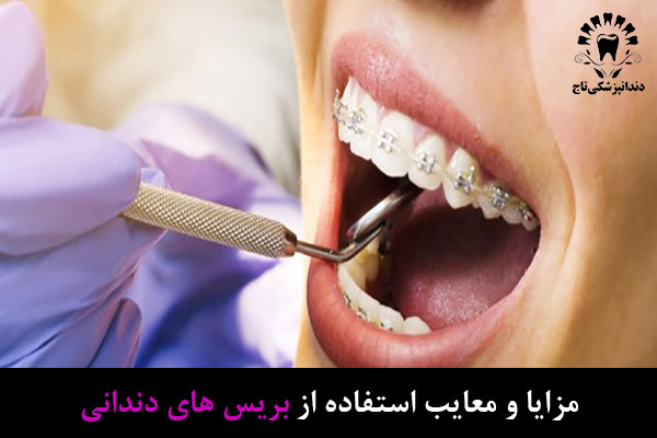 مزایا و معایب ارتودنسی دندان