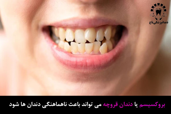 بروکسیسم باعث بد فرمی دندان