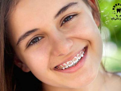 آشنایی با مراحل مختلف ارتودنسی دندان